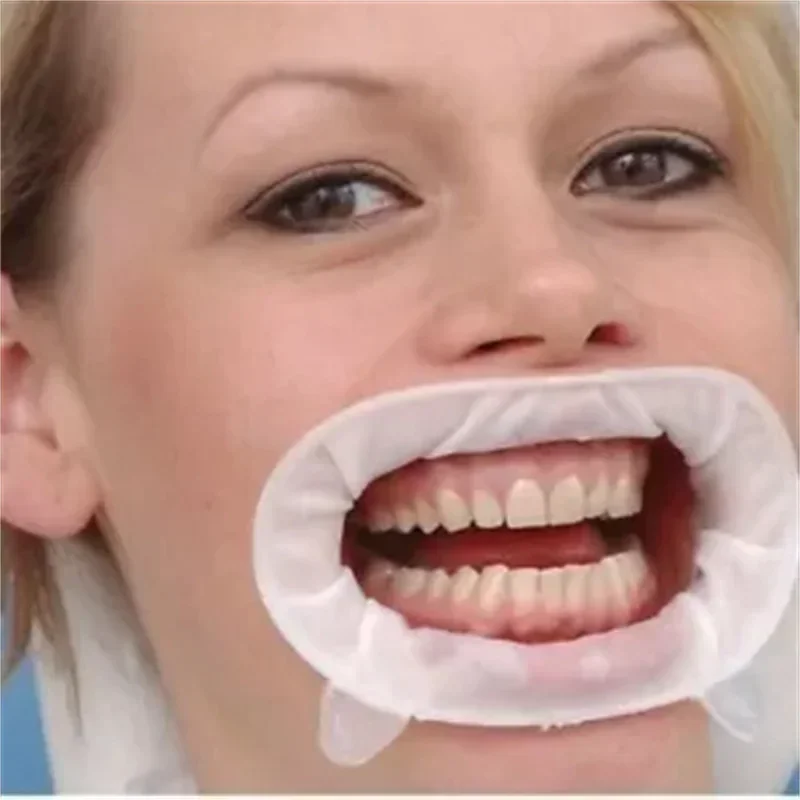 Dental Mouth Opener Optra Gate - 3D Printing Orthodontics 评论和价格